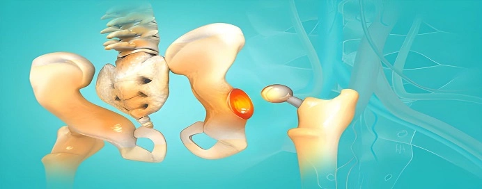 Best Hip Replacement Doctor in Andheri, Mumbai